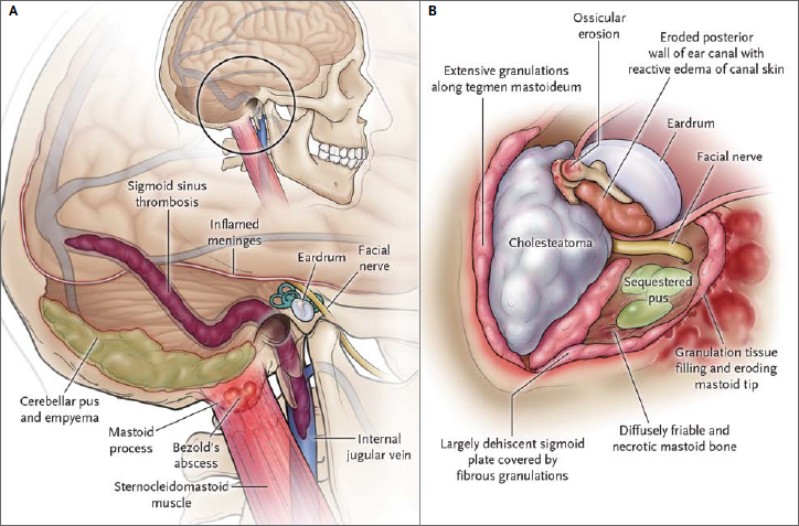 hipertóniás tentoriummal