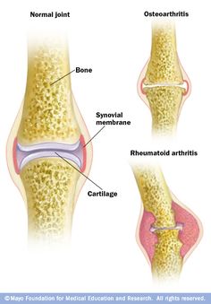 A rheumatoid arthritis kezelése