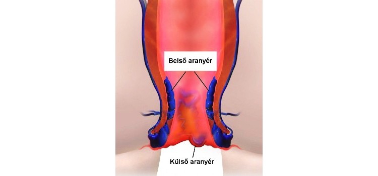 gyógyszerek aranyér ellen magas vérnyomás ellen