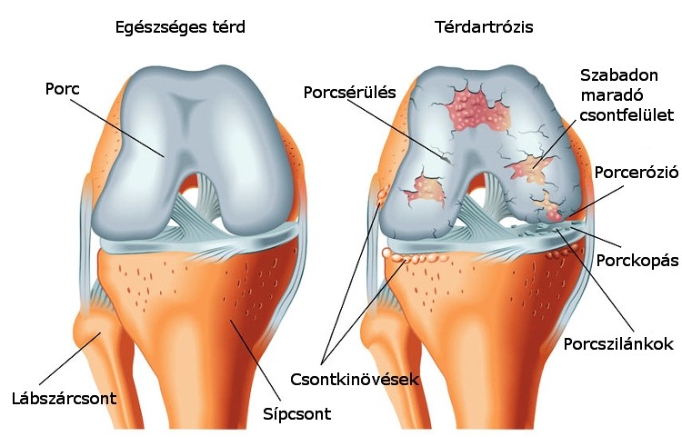 arthritis hipertónia kezelése)