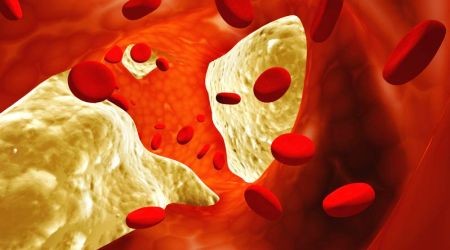 angina pectoris és magas vérnyomás kezelése)
