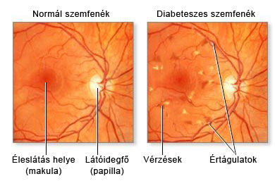 magas vérnyomás és szemfenék