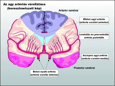 vérzéses stroke magas vérnyomás)