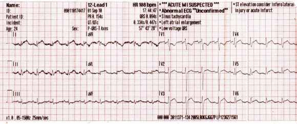 magas vérnyomás és sinus bradycardia