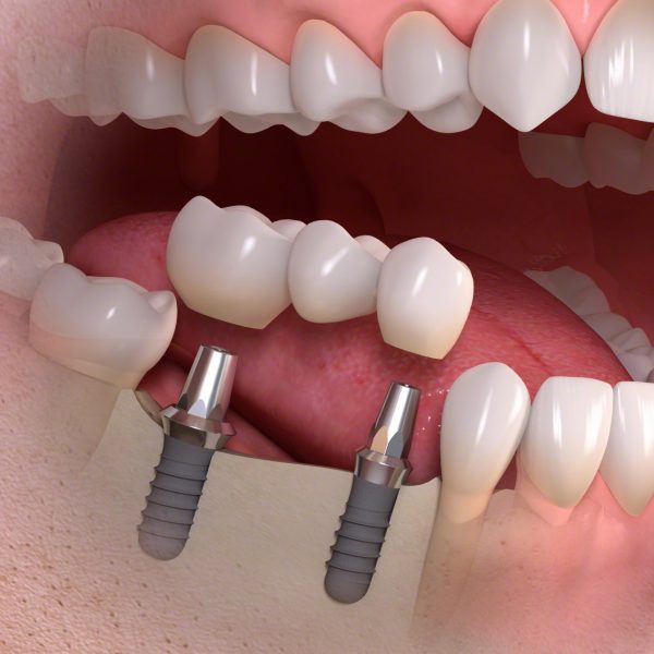implantátumok és magas vérnyomás
